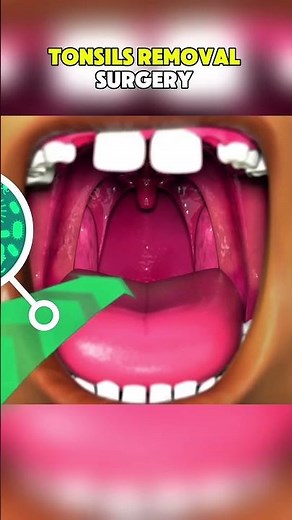 Tonsils Removal Surgery|3D ANIMATIONS| #TonsilRemoval#Tonsillectomy#TonsilsSurgery#ENTSurgery#fyp
