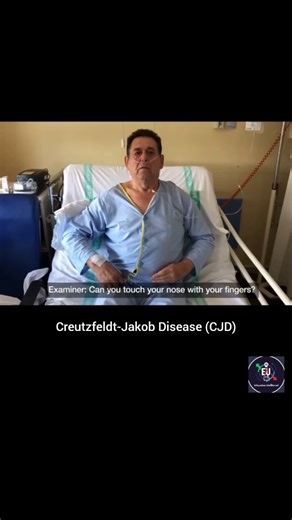 Education Unfiltered on Instagram: "This video offers a significant clinical look at the motor manifestations of Creutzfeldt-Jakob Disease (CJD), a rapidly progressive and fatal neurodegenerative disorder caused by the misfolding of prion proteins. Key Clinical Features Observed: Wing-Beating Tremor: When the patient abducts his arms and flexes his elbows (bringing his hands toward his chest), a high-amplitude, rhythmic tremor is triggered. This is often associated with dysfunction in the dentat