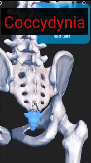 TAILBONE PAIN or coccydynia causes #tailbone