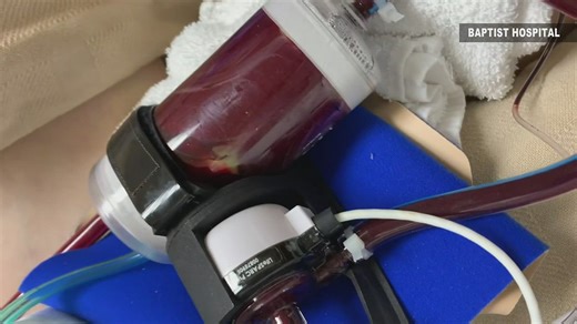 Southeast Texas now has life-saving machines that can give patients a 50-70% survival rate