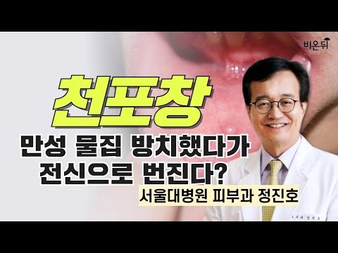 천포창 / 서울대병원 피부과 정진호