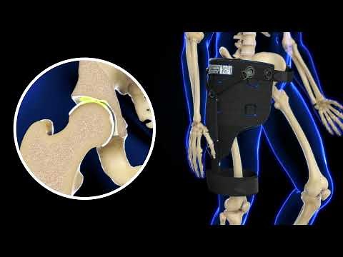 DonJoy EXCYABIR Hip Brace How it Works - Hip OA