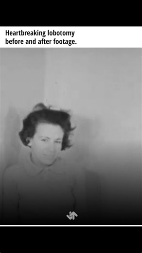 Hard to believe this was a real practice More heartbreaking before and after lobotomy stories here: https://www.ranker.com/list/lobotomies-before-and-after/jacob-shelton?utm_source=facebook&utm_medium=medium&utm_campaign=reelsclicks | Graveyard Shift