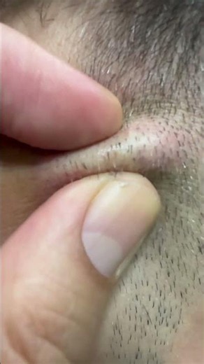 Skincare satisfying videos #pimples #pimplepopping #acne #remove #hairremoval #trendine #blackheads
