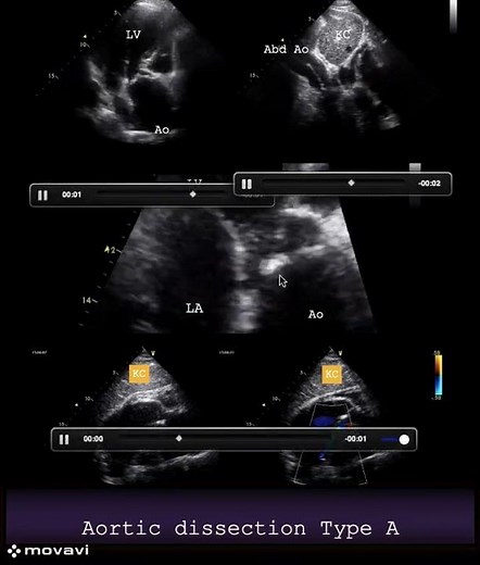 Aortic dissection Type A