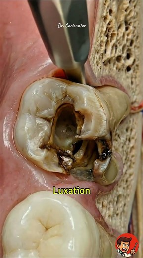When a Tooth BREAKS During Extraction!