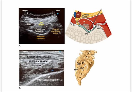 DrPrashant Tripathi MS ORTH FIAS FIJR (GERMANY) on Instagram: "Any personal experience with this ??? 🦴🔬 Sacral ESP Block – A Game-Changer in Fragile Hip Fracture Patients The Sacral Erector Spinae Plane (ESP) Block is emerging as a safe and effective regional anesthesia technique in patients with significant cardiopulmonary comorbidities, who are otherwise poor candidates for conventional spinal or general anesthesia. In procedures such as intramedullary nailing for proximal femoral fractures,