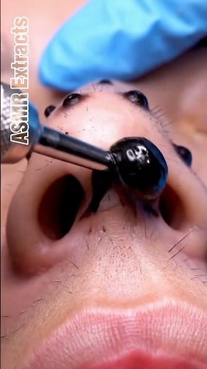 ASMR Extracts | Massive Pore Extraction