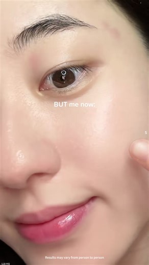 For the mornings you look in the mirror and wish for a 'soft reset'. This bottle is that gentle, dewy command for your skin. 🌅#NAD #PDRN #antiaging #beforeafter #skincaretok