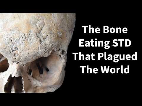 The Archaeology and History of Syphilis