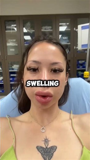 Why Do Lips Look So Swollen? 😮💋