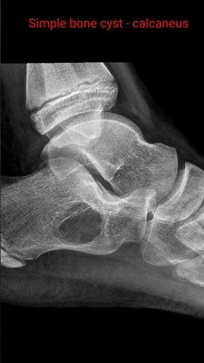 Simple bone cyst - calcaneus