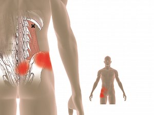 Finding & Treating Low Back Pain Trigger Points
