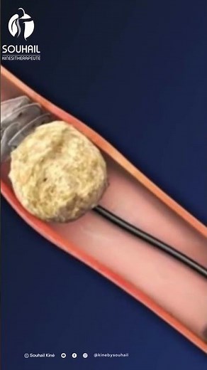 Lithotripsy: The Miracle Cure for Kidney Stones