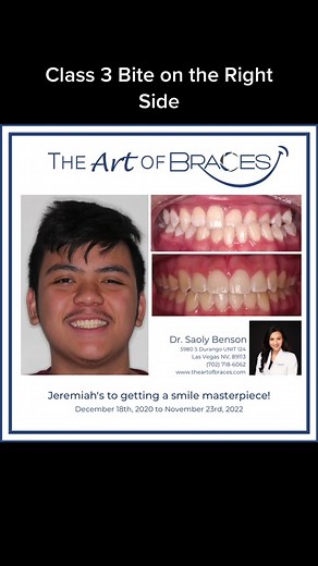 The Art of Braces on TikTok