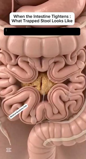 When the Intestine Tightens: What Trapped Stool Looks Like