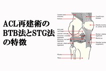 ACL再建術のBTB法とSTG法の特徴