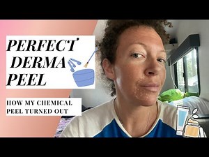 PERFECT DERMA PEEL | MY CHEMICAL PEEL EXPERIENCE