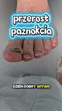 przerośnięty paznokieć #onychogryfoza #onychogryphosis #podopogotowiewarszawa #pedicureleczniczy