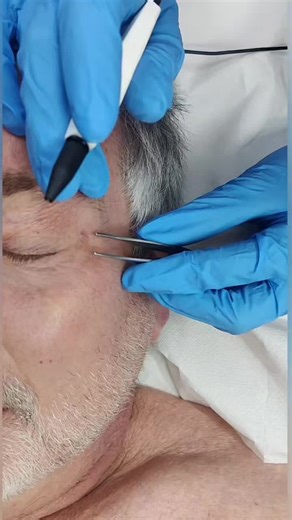 SKIN TAGS ON EYELIDS.... Although skin tags on the eyelids are usually harmless, they can cause irritation or obscure vision. #skintags #skinlesion #electroysis #skintagremoval #skintag #skinandglow #leightonbuzzard #aestheticclinic #skinclinic #eyelids #cauterisation #electrocautery
