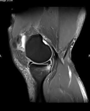 Meniscocapsular Juction Tear Knee