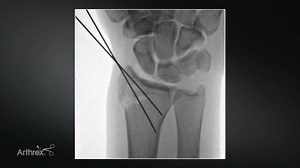 Distal Radius Fracture Management Using the NanoNeedle Scope System