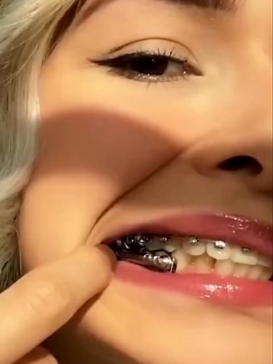 Herbst Appliance in Orthodontics: Functions and Costs