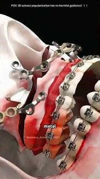 Bimaxillary osteotomy Surgery (3D Animation)#maxillaryosteotomy #osteotomysurgery