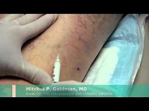 Sclerotherapy For Leg Veins | Mitchel P. Goldman, MD | San Diego