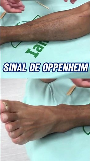 SINAL DE OPPENHEIM: SINAL NEUROLÓGICO NO AVC E ESCLEROSE MÚLTIPLA