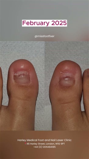 The Most Stubborn Verruca Ever? by Miss Foot Fixer Marion Yau