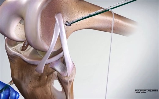 RIGIDLOOP™ Adjustable可调节线圈钛板操作动画中文版上线了