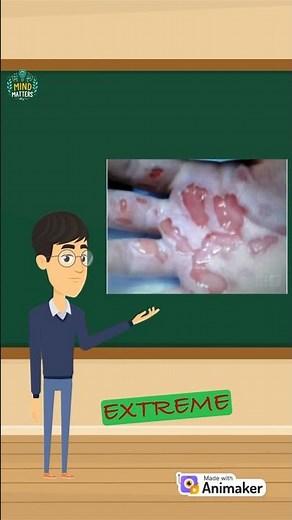 What happens when you touch Dry Ice