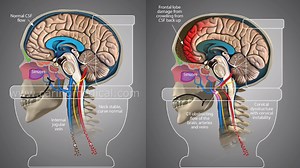 Meniere's Disease and Fluid build up in the ears - Chronic cerebrospinal venous insufficiency