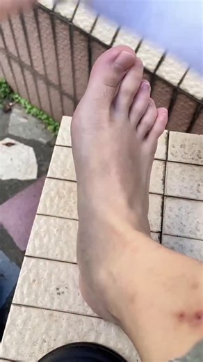 This corrector is designed to gently realign, reduce swelling, and ease that constant discomfort — so you can walk freely again. Comfort starts here. 🛒 Shop here:👉 https://linktr.ee/orderlighter #FootCareTools #ToeCorrector #PainFreeSteps #ValgusSupport | Thumb Valgus