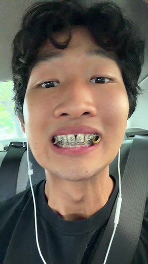 Damon Braces are in #marpe #headgear #orthodontics #damonbraces #braces