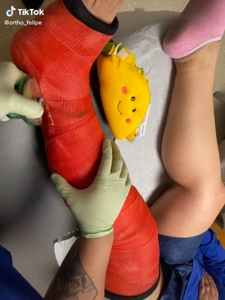Long leg cast removal! #castsaw #castremoval #orthopedics #orthopedictechnician #felipethetaco #orthofelipe #nfldraft #beforeandafter #tipsandtricks #justiceforjohnnydepp #LIKEABOMBSHELL #apifamily #mentalhealthawareness #mentalhealthmatters #fypシ゚viral #fyp