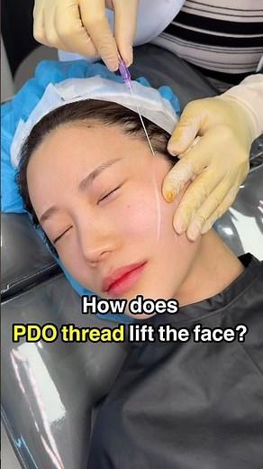 How PDO Threads Lift Your Face | Non-Surgical Face Lift Explained