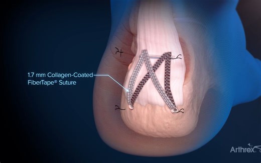 MIS FiberTak® Achilles SpeedBridge™ Repair System Animation