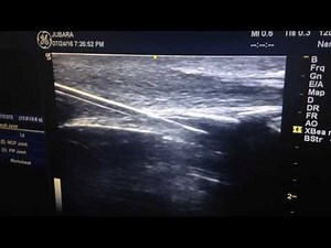 Ultrasound guided caudal epidural