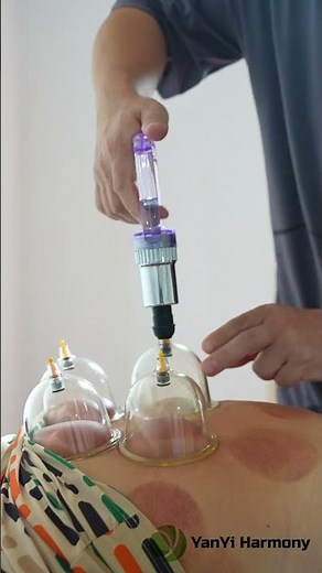 ASMR Dry Cupping Therapy