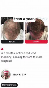 342 reactions · 28 shares | #1 Rated Hair Regrowth Device. iRESTORE offers FDA-cleared devices that have helped 500,000+ people fight hair loss, including people who experienced the following: ✔️ Receding hairline ✔️ Bald spots ✔️ Thinning crown ✔️ Widening parts We offer a 12-month money-back guarantee because we know IT WORKS! Experience it for yourself  | iRESTORE Hair Growth System | Facebook