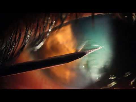 Corneal Epithelial Debridement for EBMD
