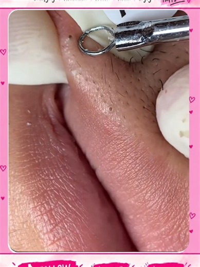 Deep Blackhead Extraction & Satisfying Popping | Wait for the most satisfying pop 😳🫣 You won’t believe what comes out! #pimplepoppersatisfying #Acne #pimple #Blackhead #Satisfying