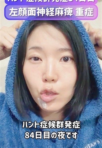 鍼治療によるハント症候群の改善比較