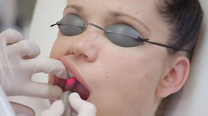 Nasolabial Fold Treatment using Fotona Laser | Clinique Chloe