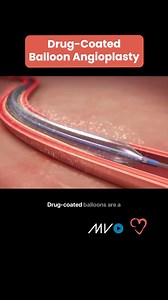 💊🎈Drug-Coated Balloons (DCBs): Transforming Vascular Care DCBs are revolutionizing how we treat narrowed blood vessels! Unlike plain old balloon angioplasty (POBA), DCBs do more than just restore blood flow, they deliver an antiproliferative drug directly to the vessel wall for long-lasting results. ➡️ DCB Advantages: 🔹 Reduces Restenosis Risk: The drug minimizes excessive cell growth, keeping vessels open longer. 🔹 No Stent Needed: Ideal for small vessels or situations where stents aren’t p