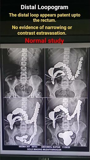 Distal Loopogram #Normalstudy