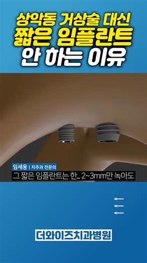 짦은 임플란트를 식립하면 생기는 일