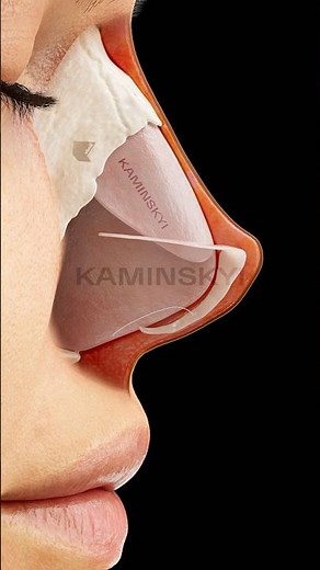 Upturned nose and its correction ⭕️ KAMINSKYI